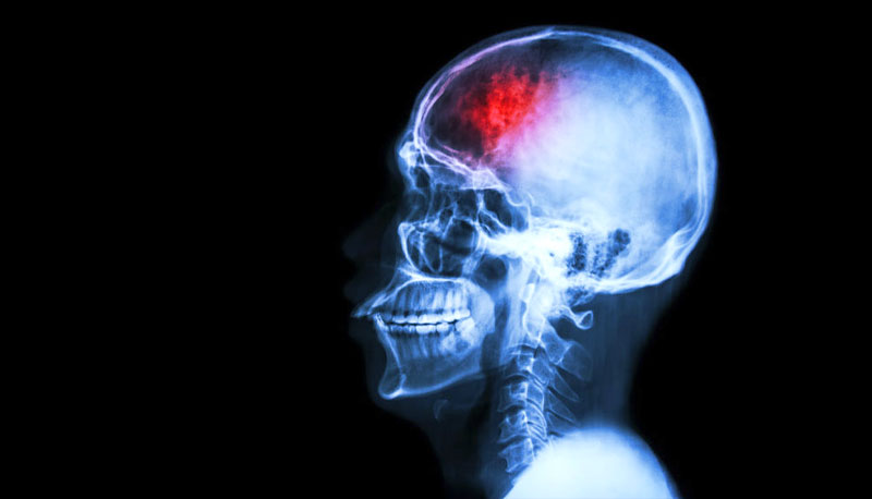 human skull