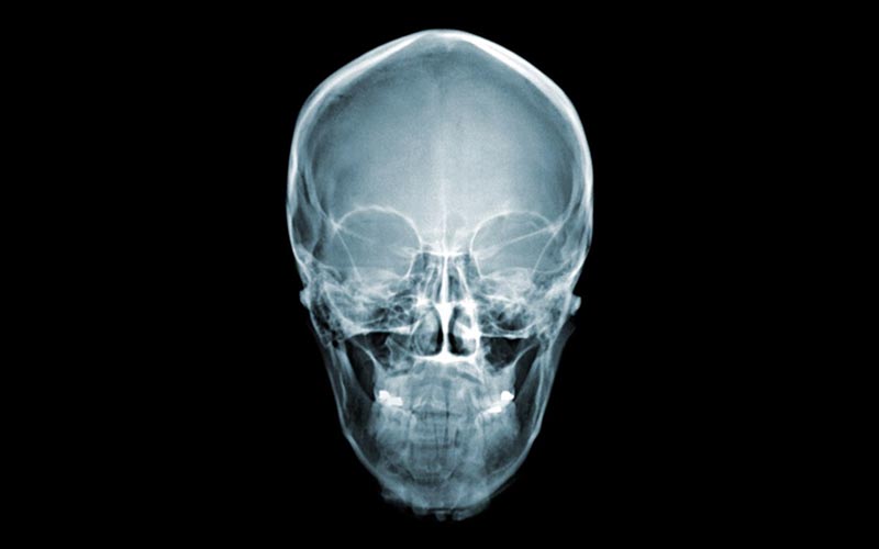 skull