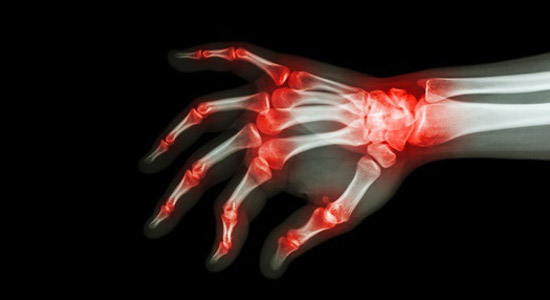 xray image of human wrist with rheumatoid arthritis