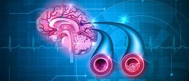 vascular brain dementia