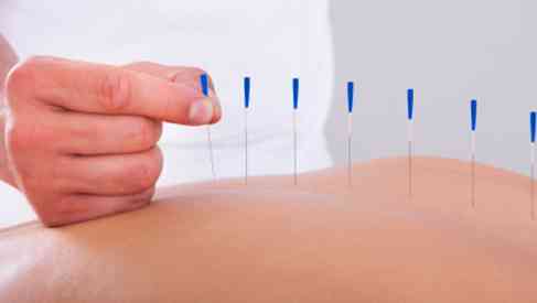 acupuncture therapy