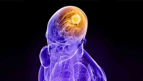 brain cancer