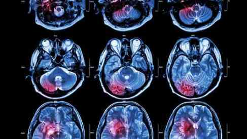 MRI of human brain
