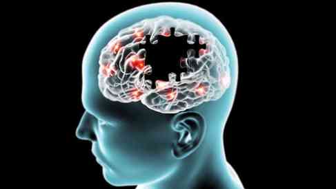 brain with Alzheimer's disease scan