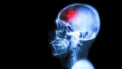 human skull