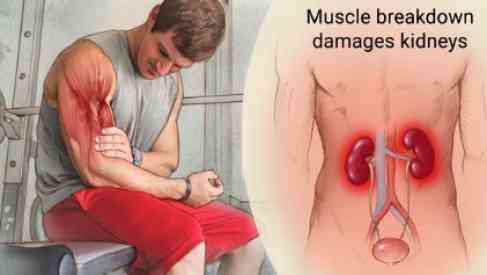 rhabdomyolysis