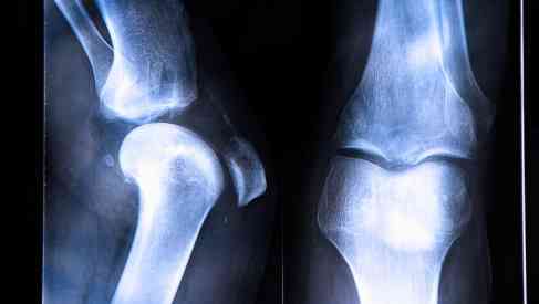 New Hope for ACL Injuries PLUS GHRP6 to Cure GERD