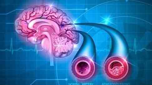 vascular brain dementia